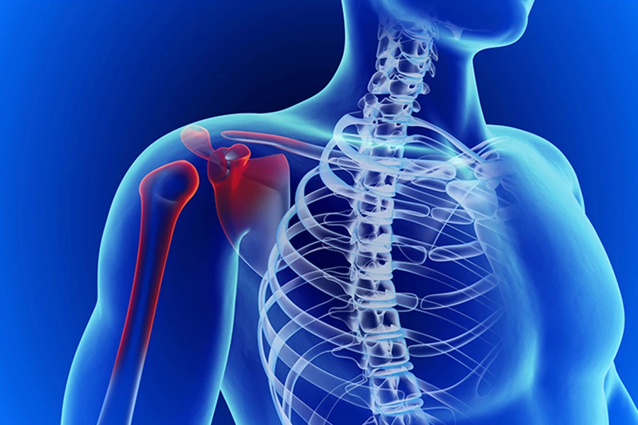 Захворювання плечового суглоба: чим можуть допомогти ортопедичні бандажі?